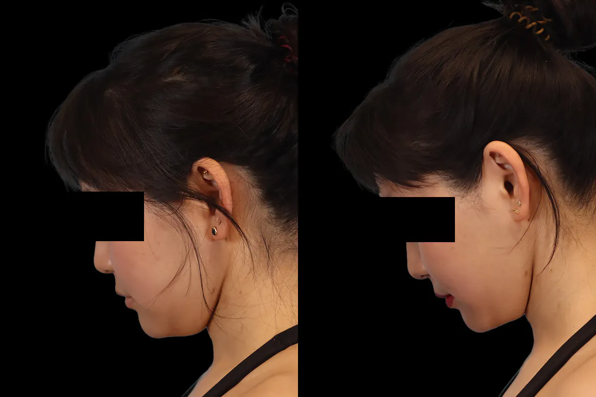 Buccal Fat Removal Before and After | Leong Facial Plastic Surgery