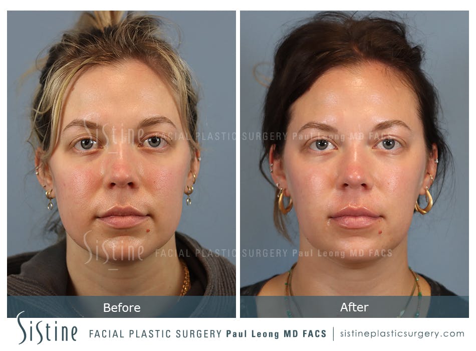Buccal Fat Removal Before and After | Leong Facial Plastic Surgery