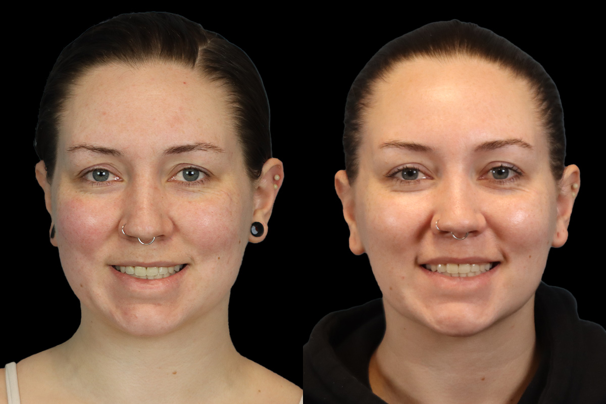 Buccal Fat Removal Before and After | Leong Facial Plastic Surgery