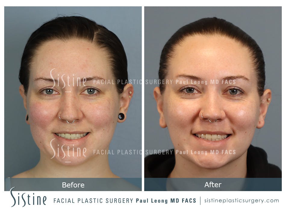 Buccal Fat Removal Before and After | Leong Facial Plastic Surgery
