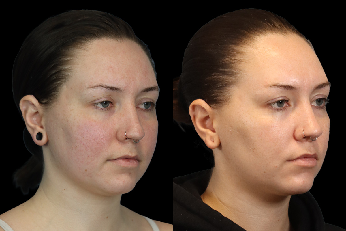Buccal Fat Removal Before and After | Leong Facial Plastic Surgery
