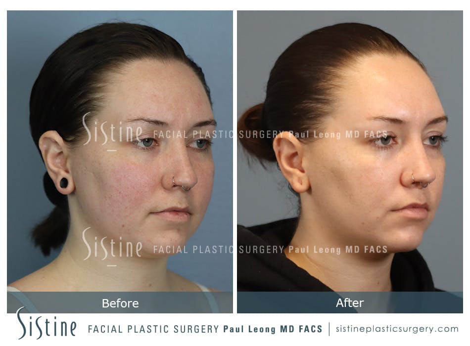 Buccal Fat Removal Before and After | Leong Facial Plastic Surgery