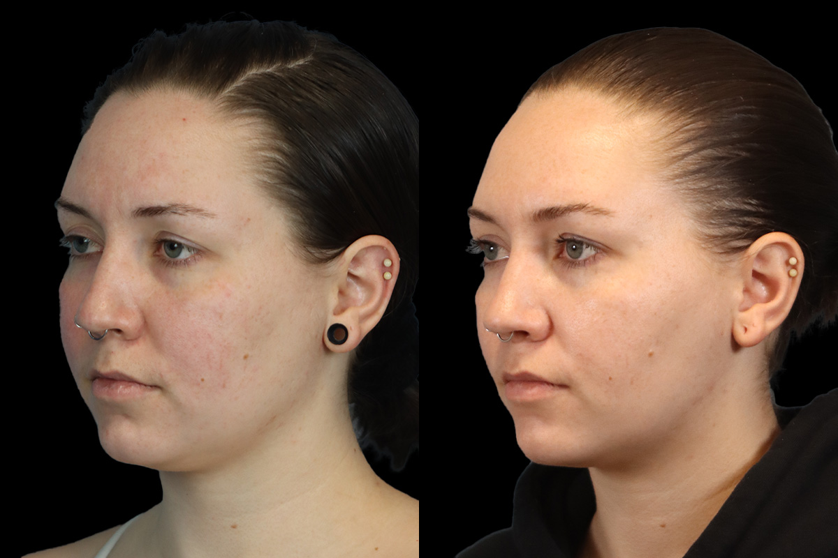Buccal Fat Removal Before and After | Leong Facial Plastic Surgery