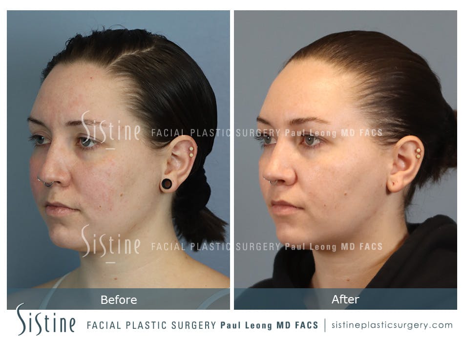 Buccal Fat Removal Before and After | Leong Facial Plastic Surgery