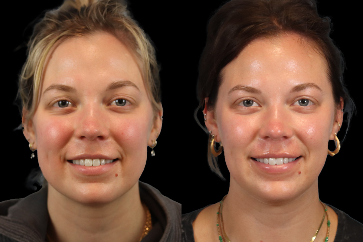 Buccal Fat Removal Before and After | Leong Facial Plastic Surgery