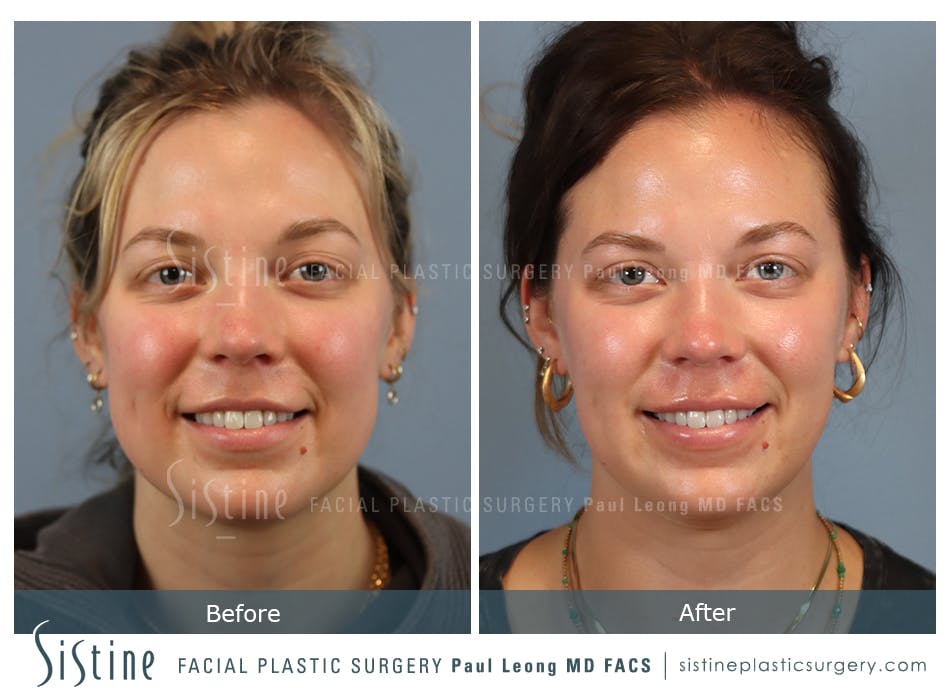 Buccal Fat Removal Before and After | Leong Facial Plastic Surgery