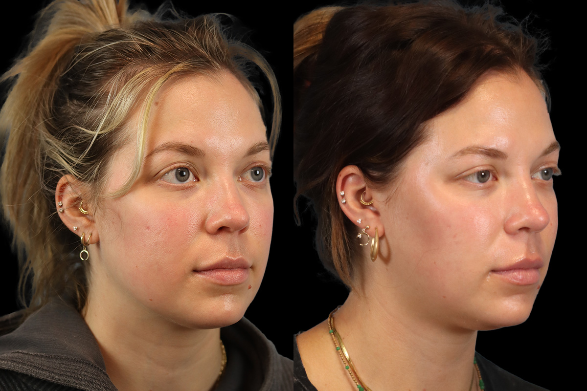 Buccal Fat Removal Before and After | Leong Facial Plastic Surgery