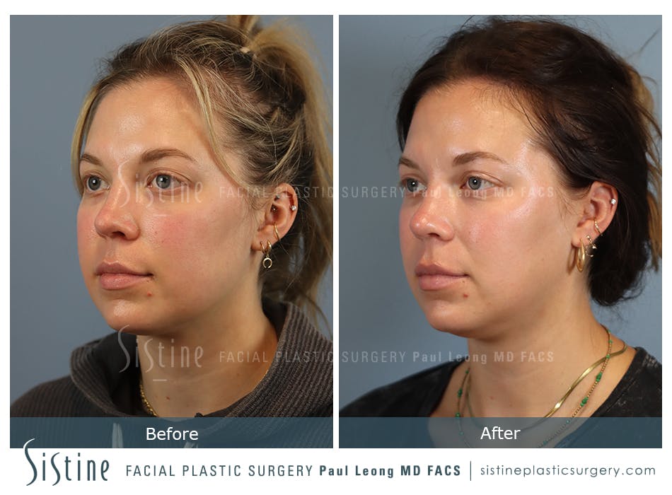 Buccal Fat Removal Before and After | Leong Facial Plastic Surgery