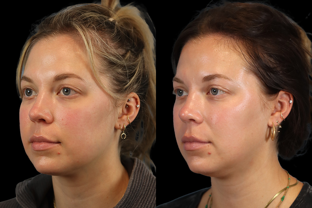 Buccal Fat Removal Before and After | Leong Facial Plastic Surgery