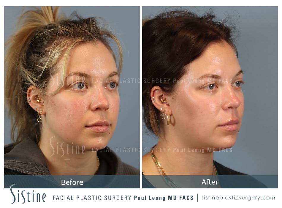 Buccal Fat Removal Before and After | Leong Facial Plastic Surgery