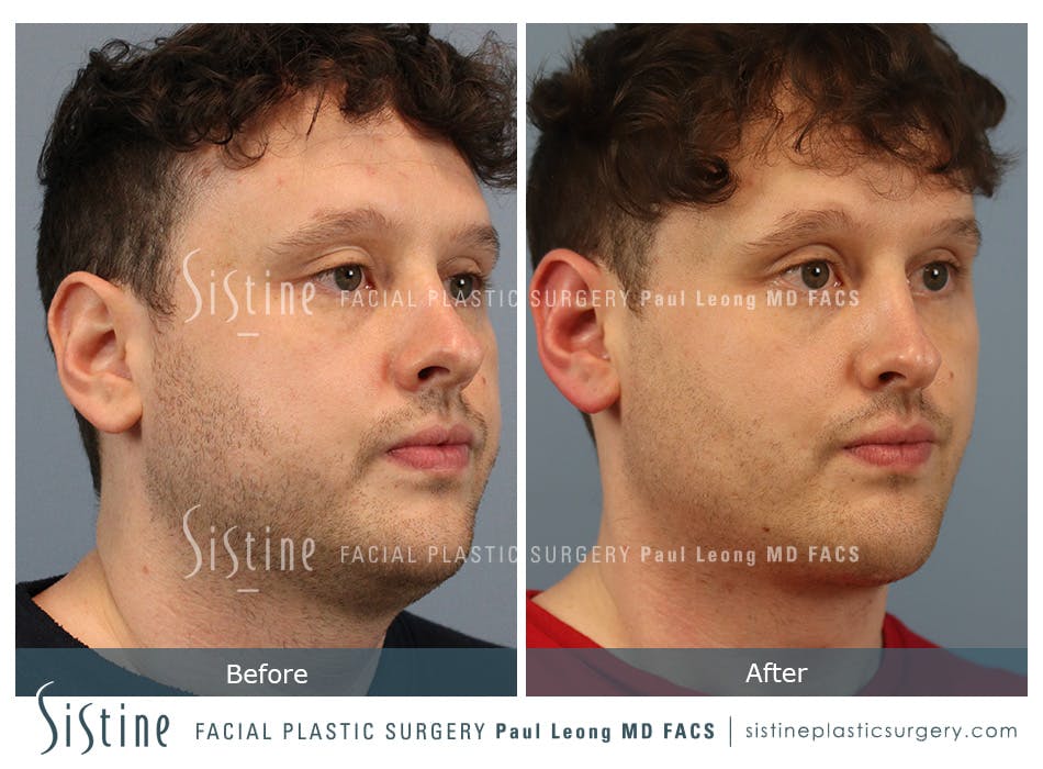 Buccal Fat Removal Before and After | Leong Facial Plastic Surgery