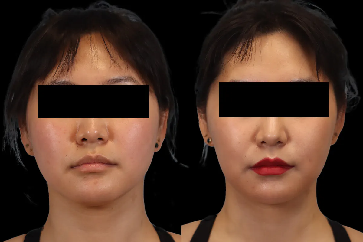 Buccal Fat Removal Before and After | Leong Facial Plastic Surgery