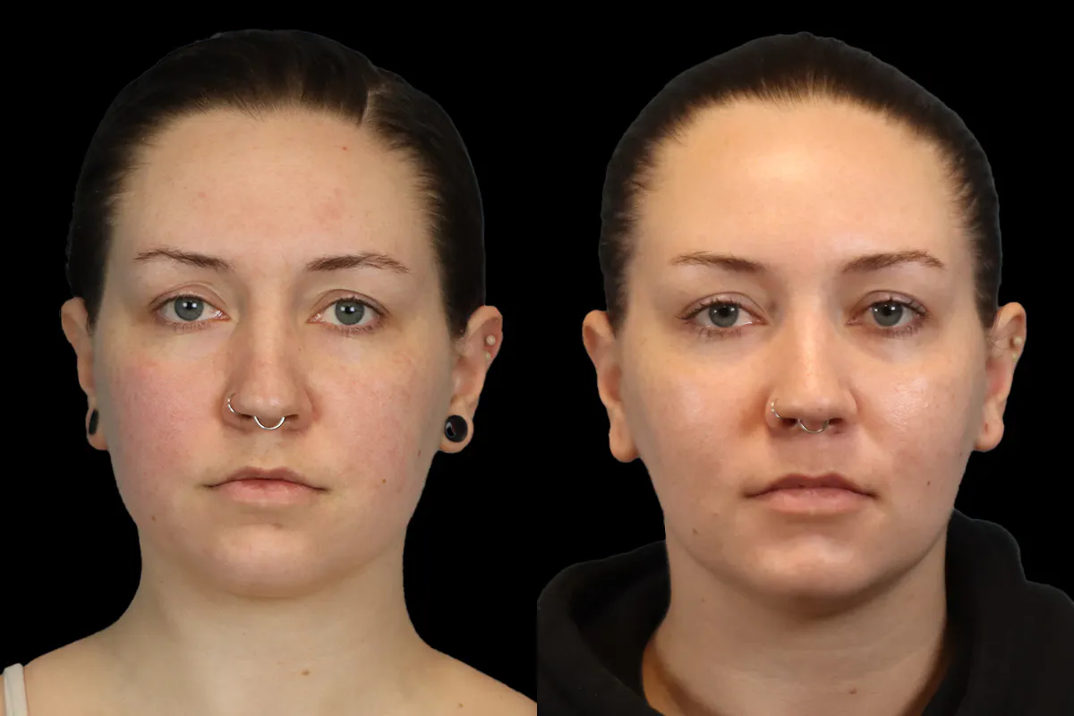 Buccal Fat Removal Before and After | Leong Facial Plastic Surgery