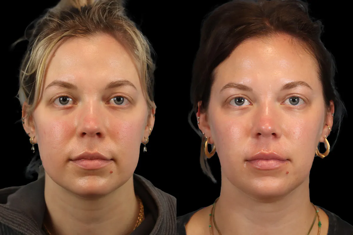 Buccal Fat Removal Before and After | Leong Facial Plastic Surgery