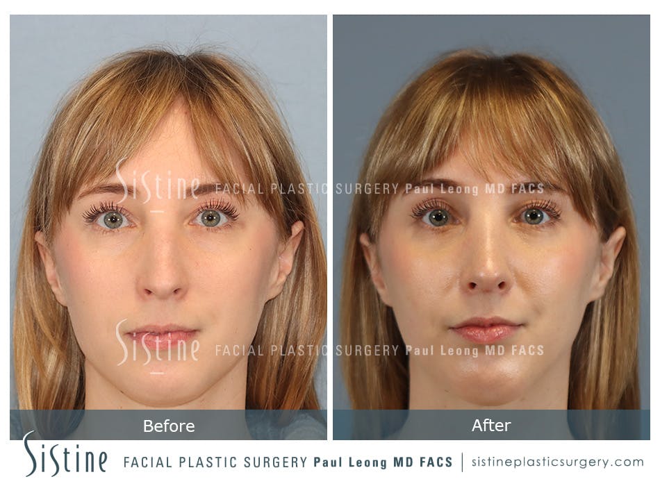 Chin Implant Before and After | Leong Facial Plastic Surgery