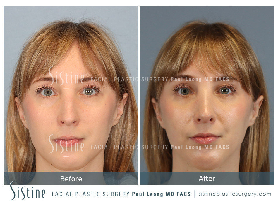 Chin Implant Before and After | Leong Facial Plastic Surgery