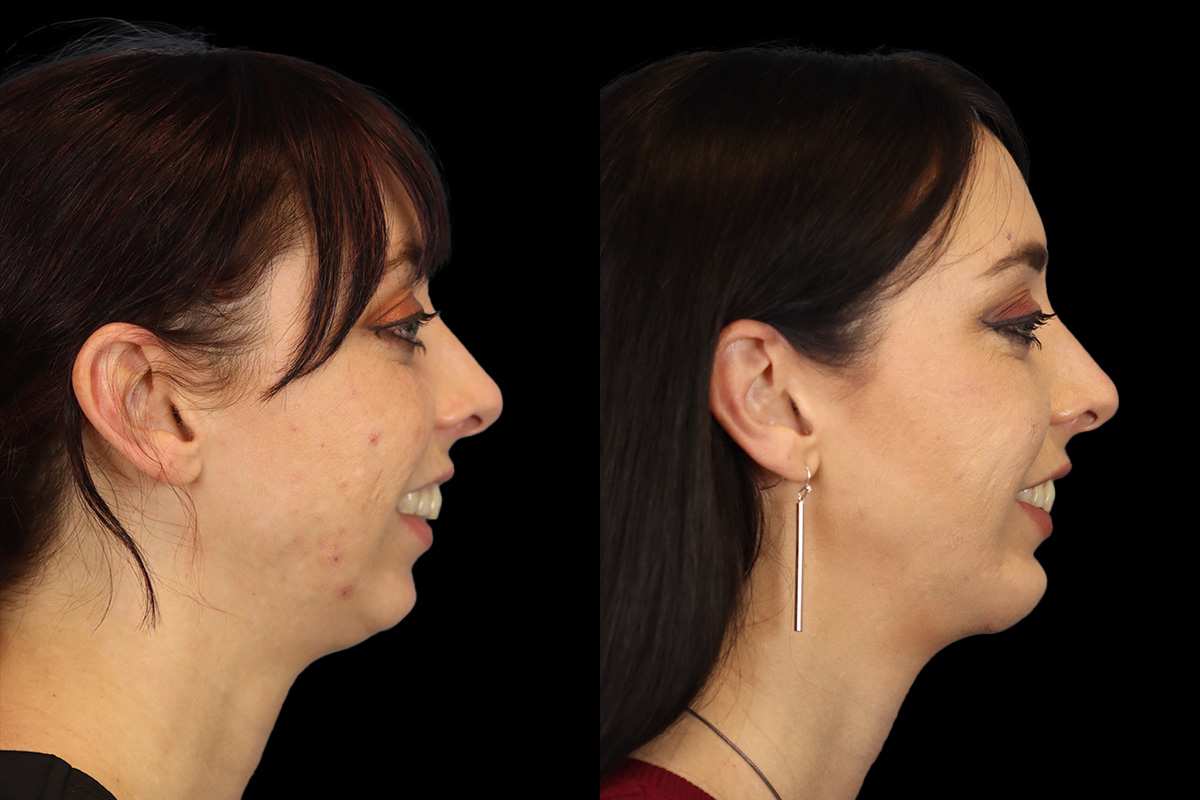 Chin Implant Before and After | Leong Facial Plastic Surgery
