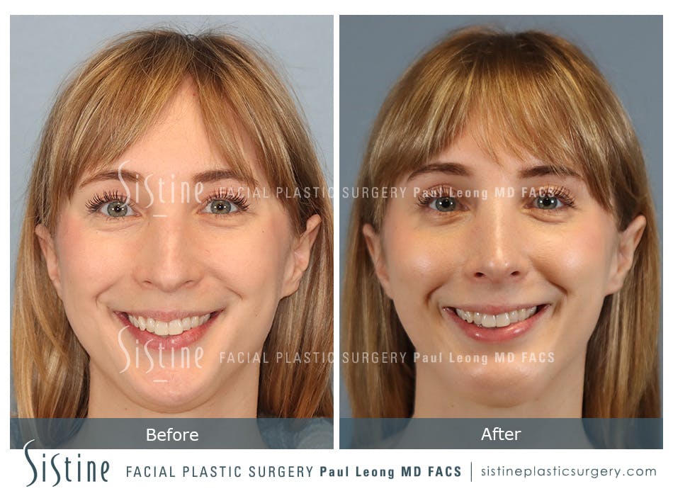 Chin Implant Before and After | Leong Facial Plastic Surgery