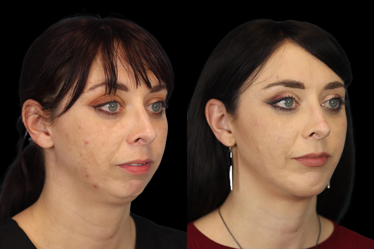 Chin Implant Before and After | Leong Facial Plastic Surgery