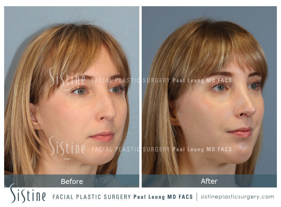 Chin Implant Before and After | Leong Facial Plastic Surgery