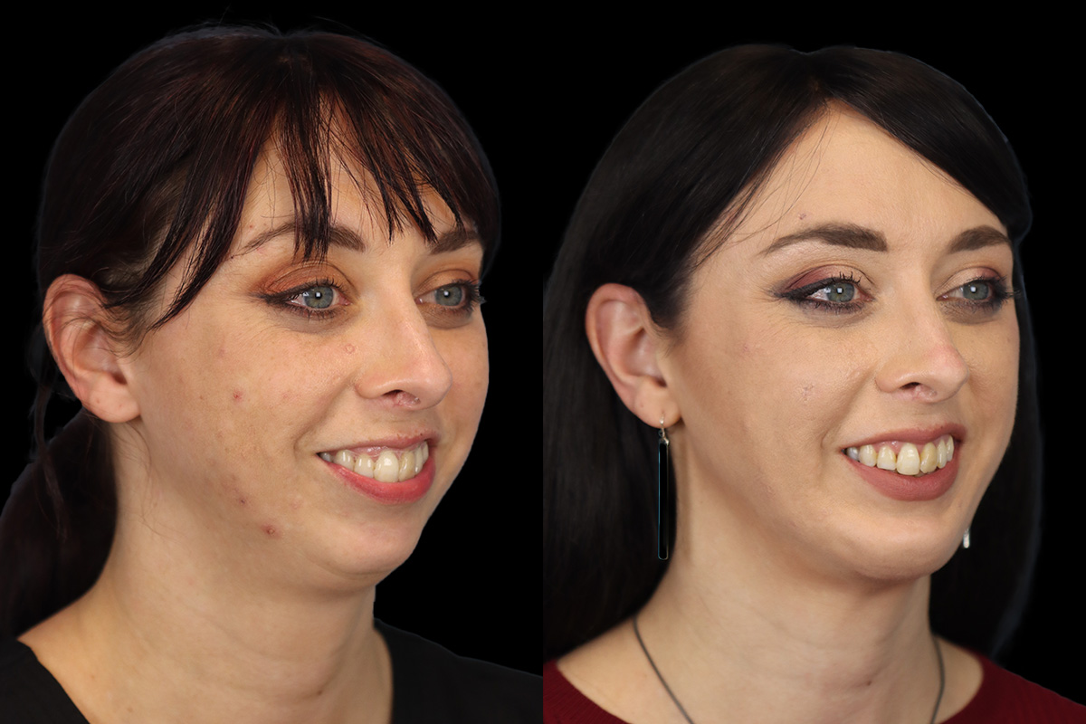 Chin Implant Before and After | Leong Facial Plastic Surgery