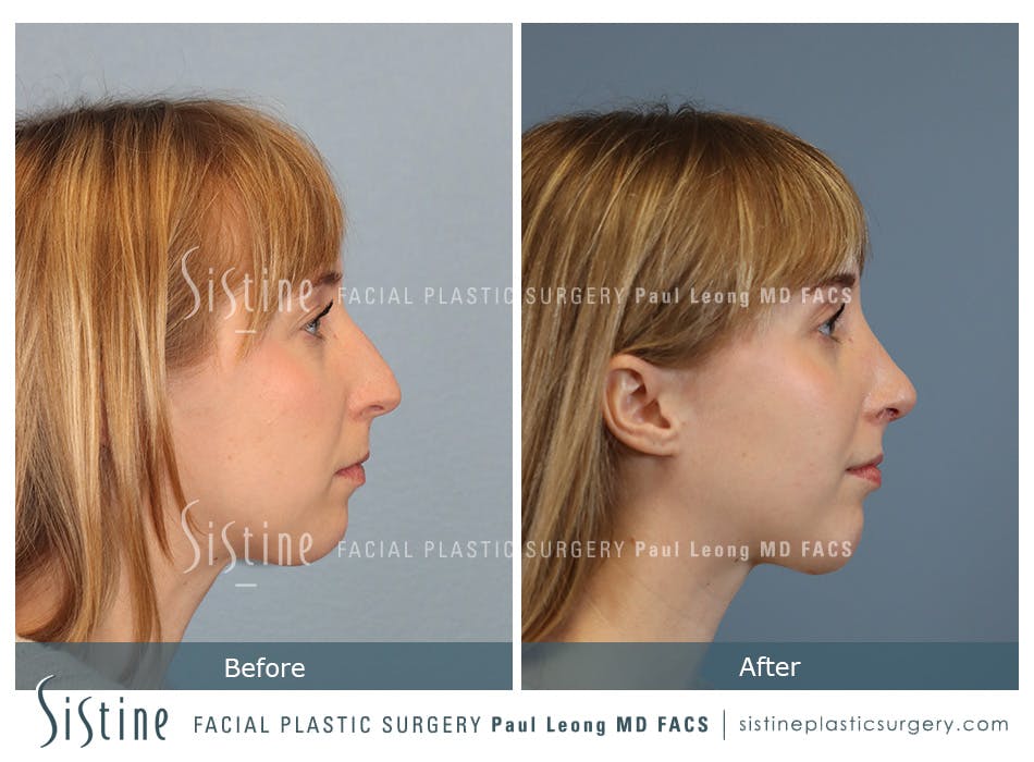 Chin Implant Before and After | Leong Facial Plastic Surgery