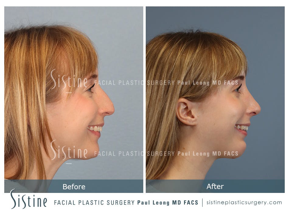 Chin Implant Before and After | Leong Facial Plastic Surgery