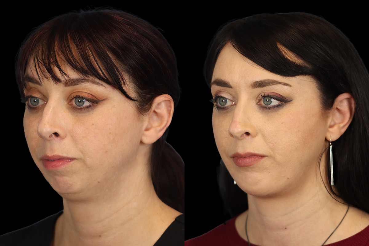 Chin Implant Before and After | Leong Facial Plastic Surgery