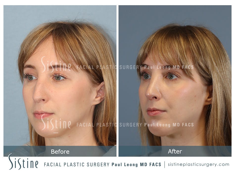 Chin Implant Before and After | Leong Facial Plastic Surgery