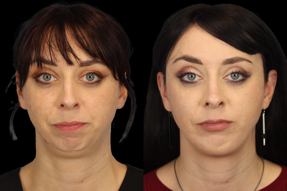 Chin Implant Before and After | Leong Facial Plastic Surgery