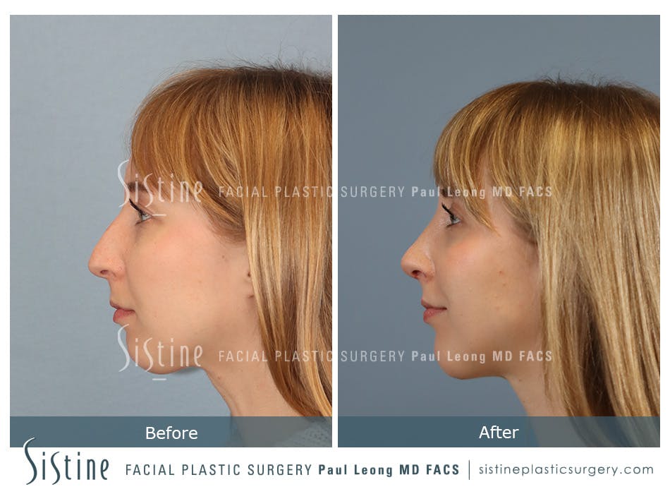 Chin Implant Before and After | Leong Facial Plastic Surgery