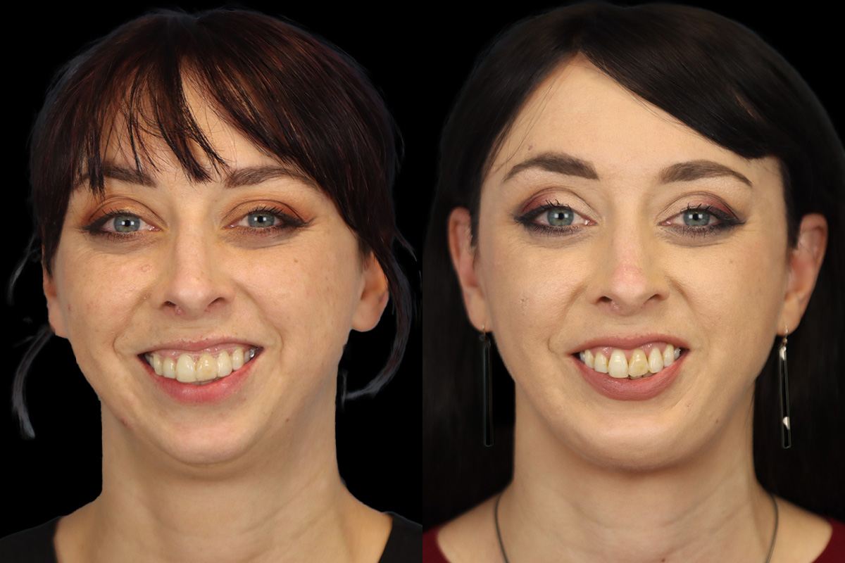 Chin Implant Before and After | Leong Facial Plastic Surgery