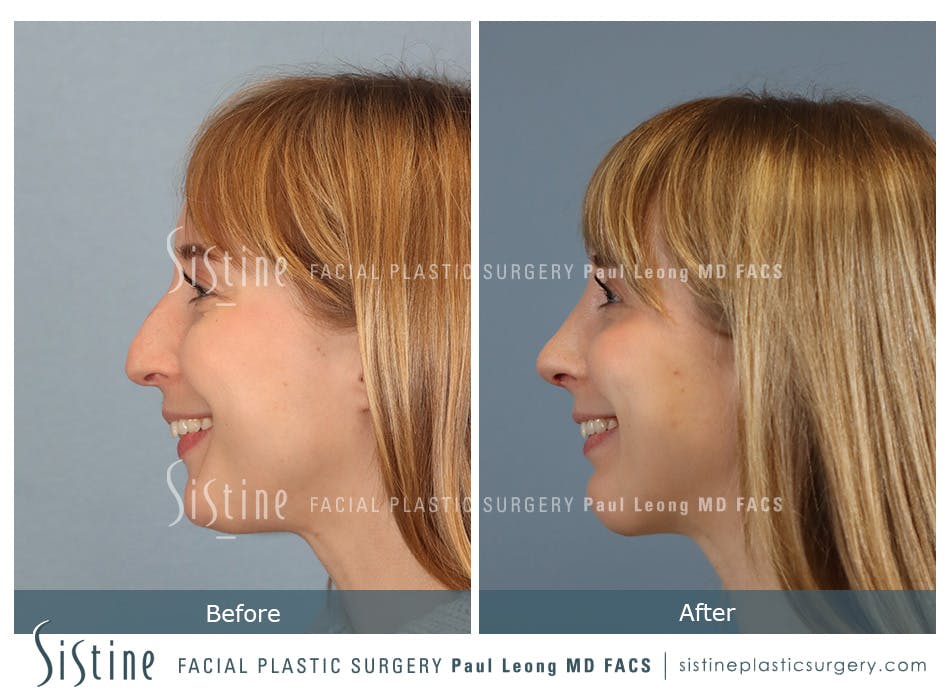 Chin Implant Before and After | Leong Facial Plastic Surgery