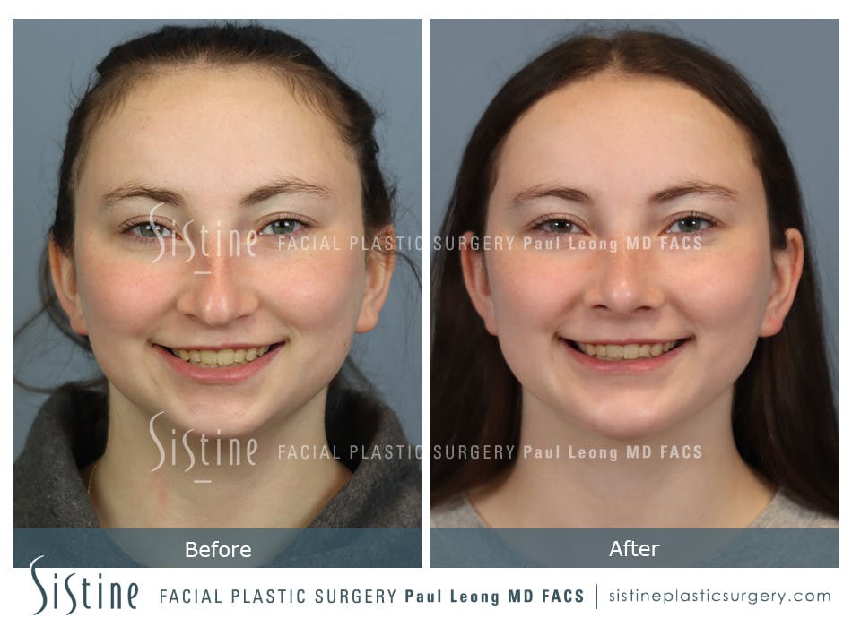 Chin Implant Before and After | Leong Facial Plastic Surgery
