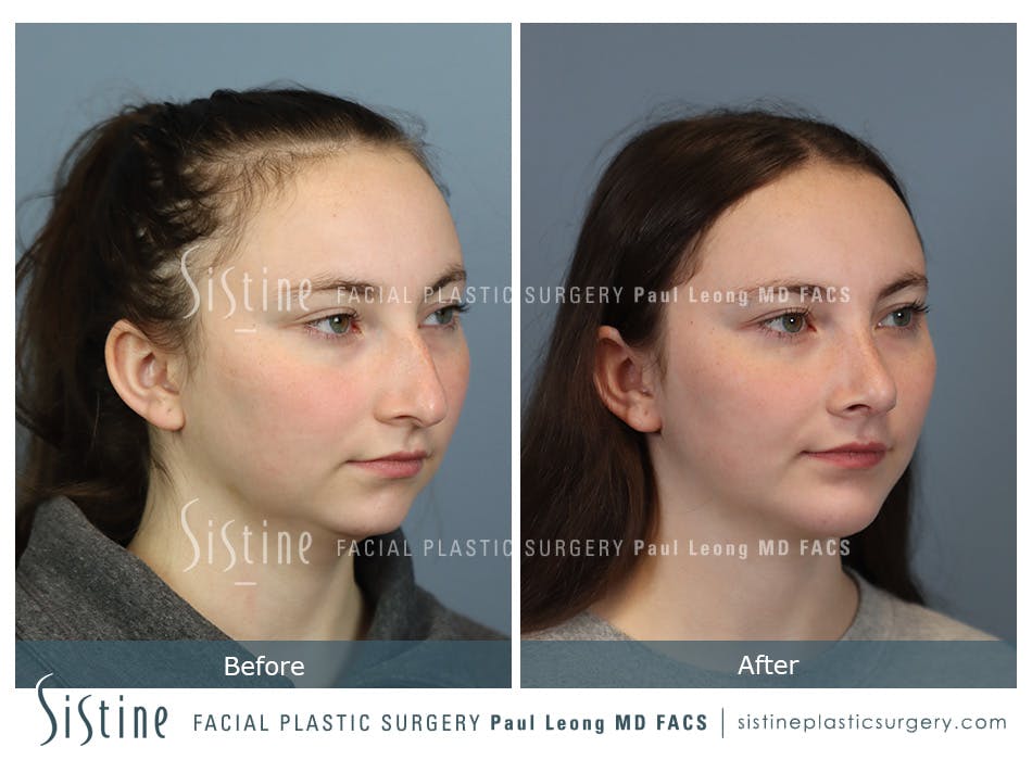 Chin Implant Before and After | Leong Facial Plastic Surgery