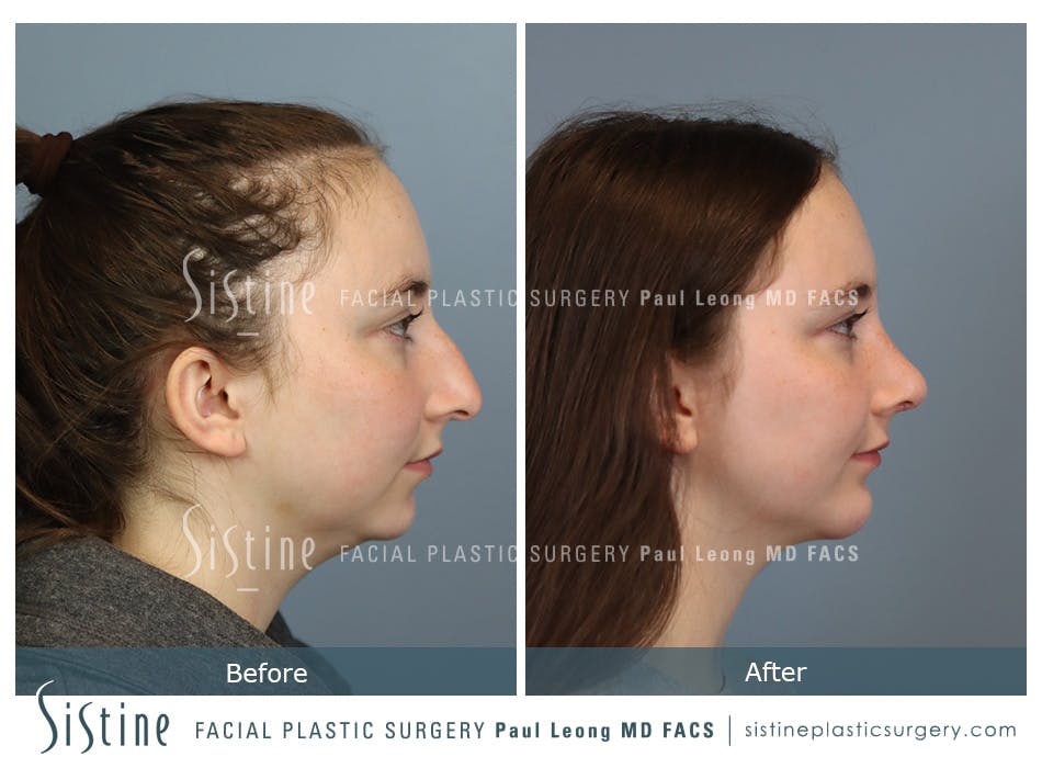 Chin Implant Before and After | Leong Facial Plastic Surgery