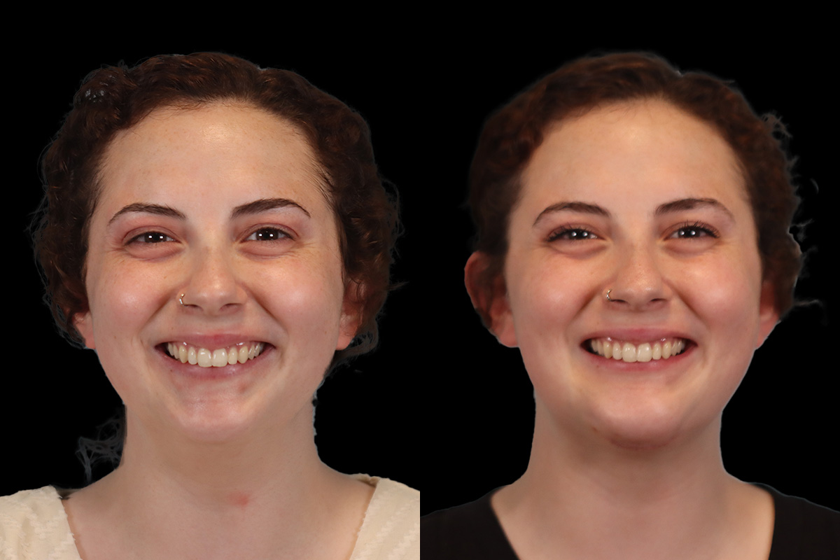 Chin Implant Before and After | Leong Facial Plastic Surgery