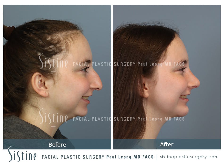 Chin Implant Before and After | Leong Facial Plastic Surgery