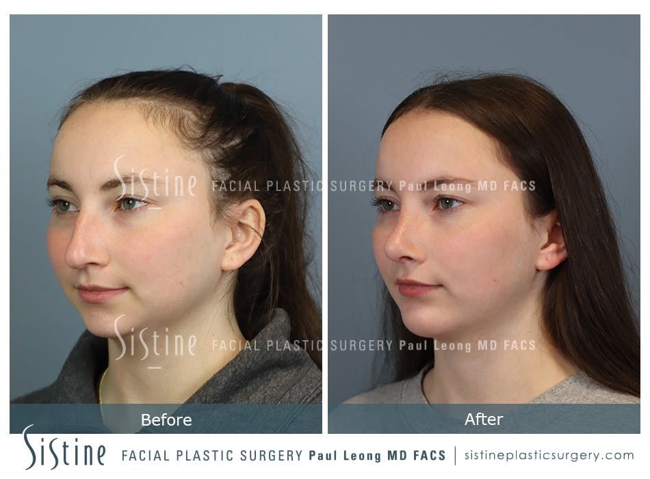Chin Implant Before and After | Leong Facial Plastic Surgery