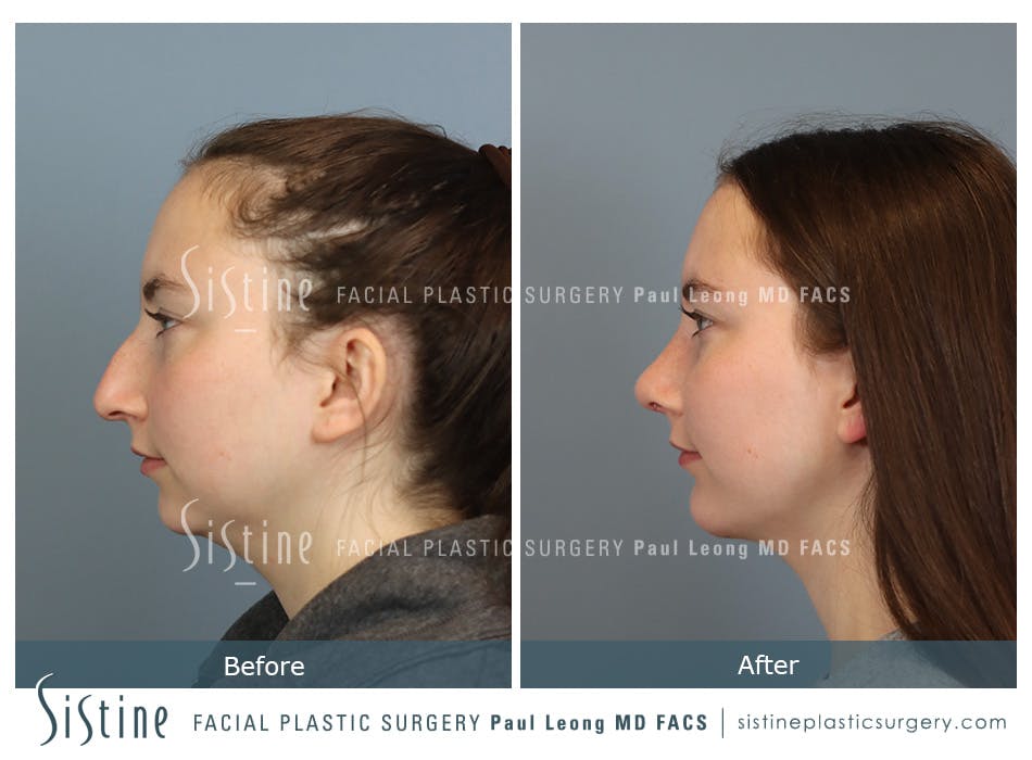 Chin Implant Before and After | Leong Facial Plastic Surgery