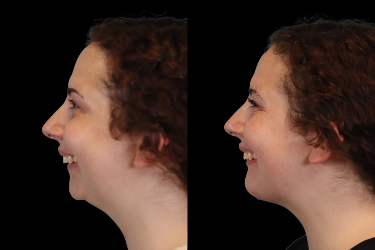 Chin Implant Before and After | Leong Facial Plastic Surgery