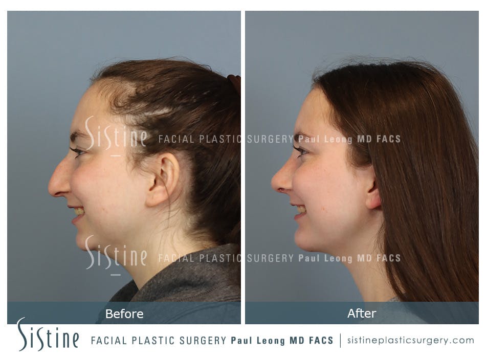 Chin Implant Before and After | Leong Facial Plastic Surgery