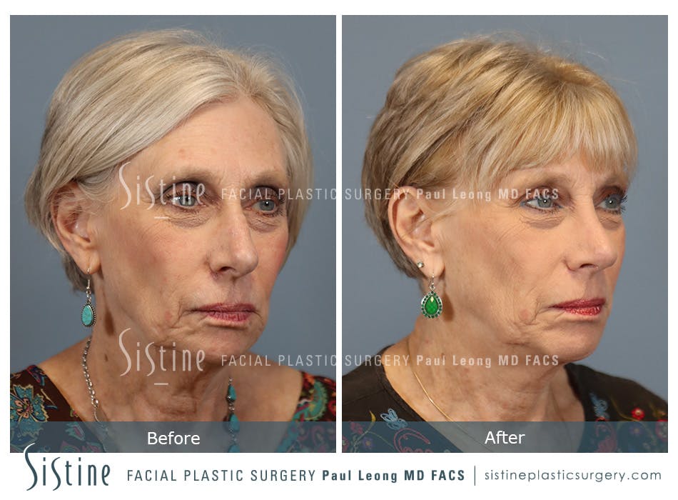 Chin Implant Before and After | Leong Facial Plastic Surgery