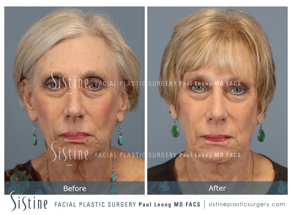 Chin Implant Before and After | Leong Facial Plastic Surgery