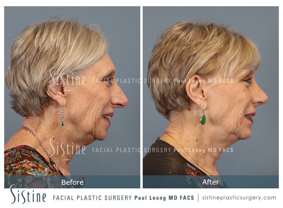 Chin Implant Before and After | Leong Facial Plastic Surgery
