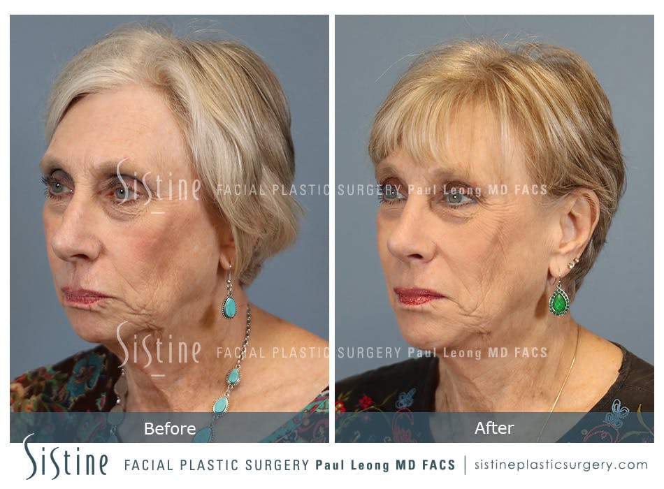 Chin Implant Before and After | Leong Facial Plastic Surgery