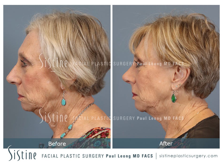 Chin Implant Before and After | Leong Facial Plastic Surgery