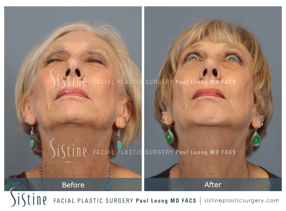 Chin Implant Before and After | Leong Facial Plastic Surgery