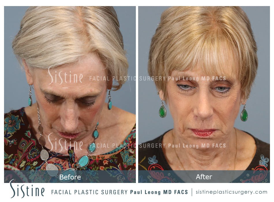 Chin Implant Before and After | Leong Facial Plastic Surgery
