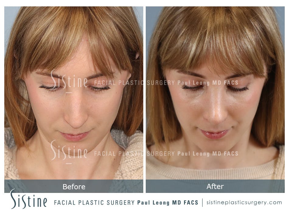 Chin Implant Before and After | Leong Facial Plastic Surgery